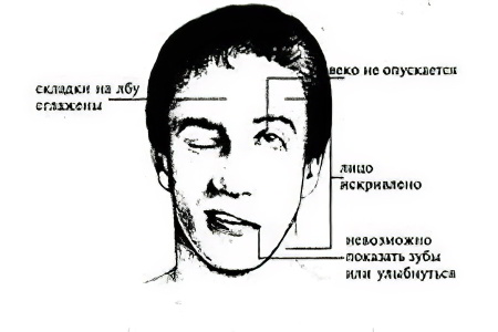 Признаки инсульта у женщин и мужчин