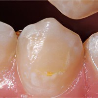 Чем снять отек щеки от больного зуба