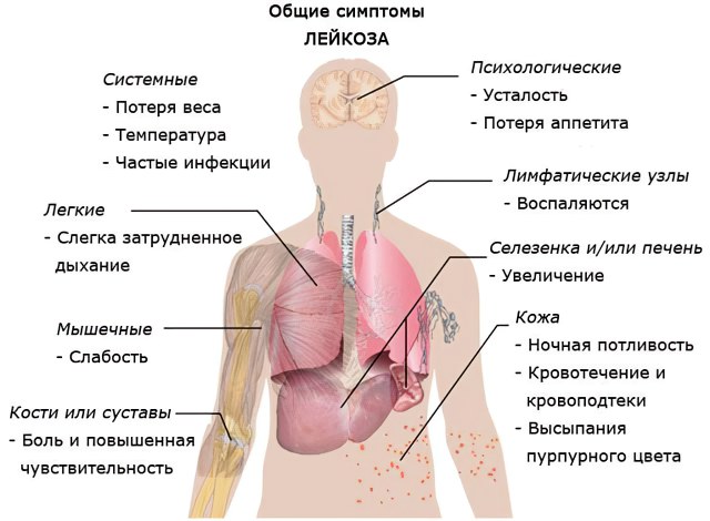 Симптомы заболевания