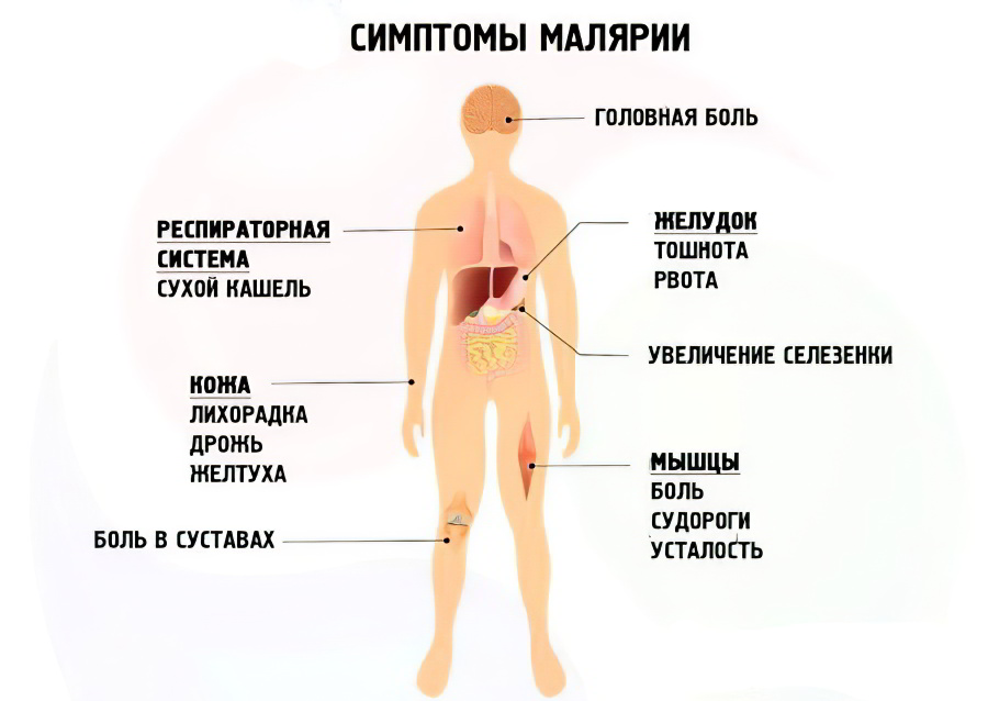 Симптомы малярии