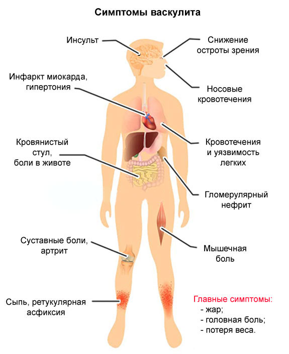 simptomi vaskylita6564