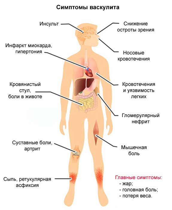 Симптомы васкулита