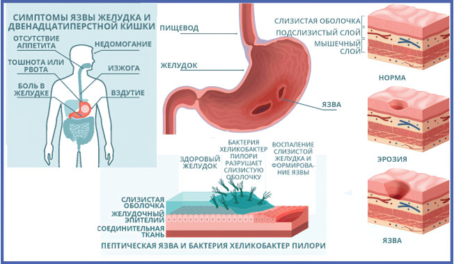 Симптомы язвы двенадцатиперстной кишки