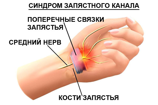 Синдром запястного канала