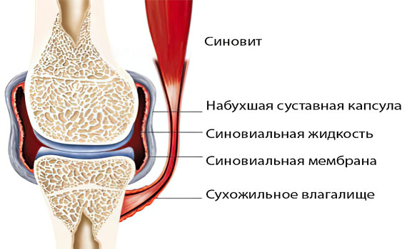 Синовит