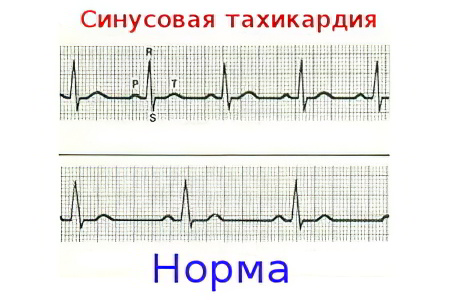 Синусовая тахикардия сердца