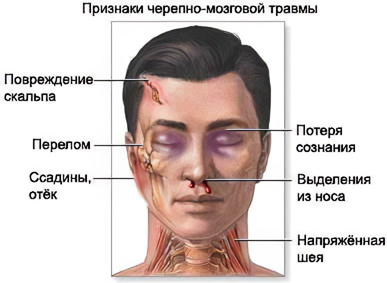 Сотрясение мозга у взрослого – признаки, симптомы и лечение