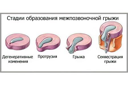 Стадии грыжи межпозвоночного диска