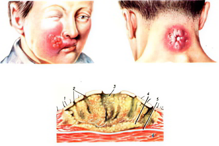 Стадии и локализации карбункула