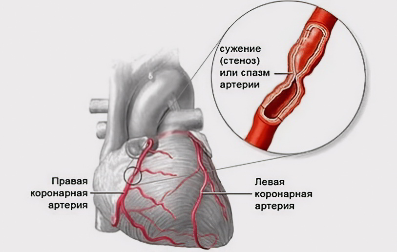 Стеноз коронарных артерий