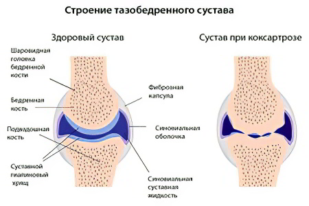 Степени и симптомы развития коксартроза Степени и симптомы развития коксартроза