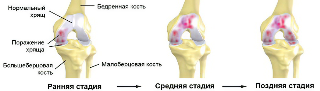 Степени артроза