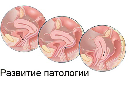 Степени опущения матки