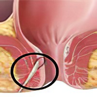 Как вылечить свищ заднего прохода народными средствами