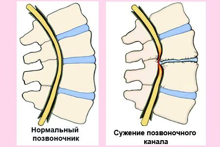 Сужение позвоночного канала