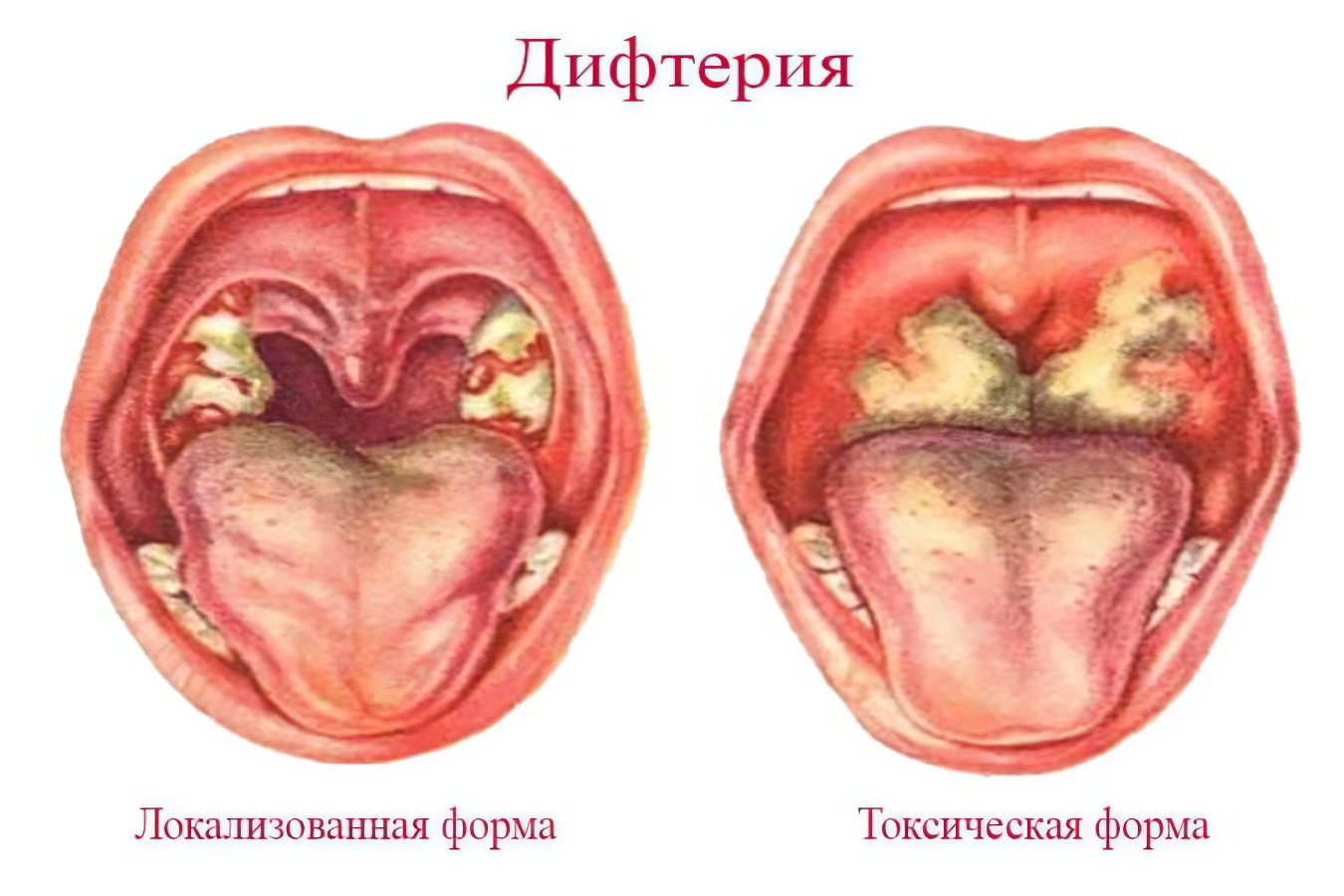 Дифтерия зева токсическая