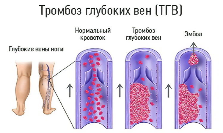 тромбоз глубоких