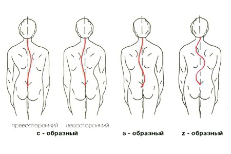 Виды сколиоза