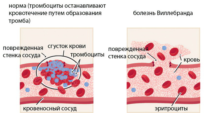 Болезнь Виллебранда