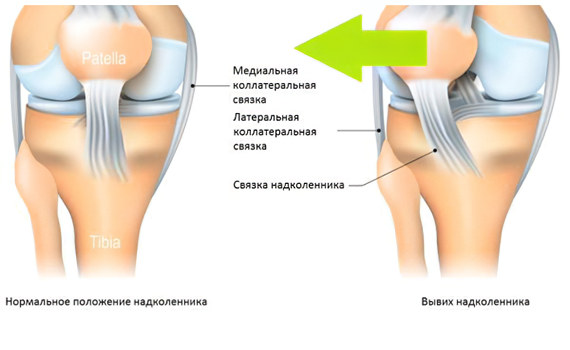 Вывих сустава