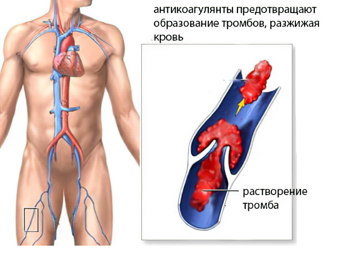 волчаночного антикоагулянта волчаночного антикоагулянта