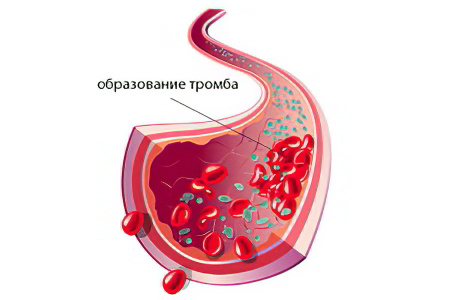 Воспалительный процесс Воспалительный процесс