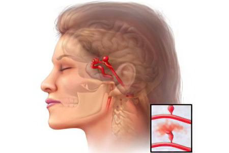Аневризма сосудов головного мозга: 10 признаков разрыва аневризмы