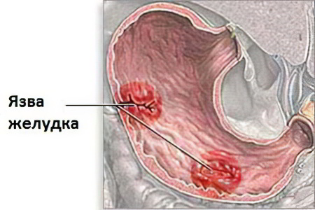 язва желудка