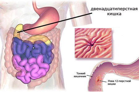 Язва двенадцатиперстной кишки