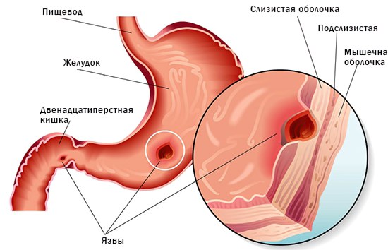 Что это за заболевание