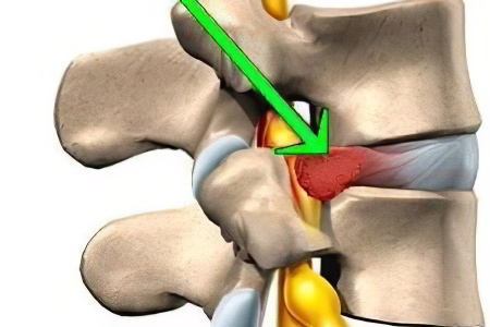 Ущемление межпозвоночной грыжи