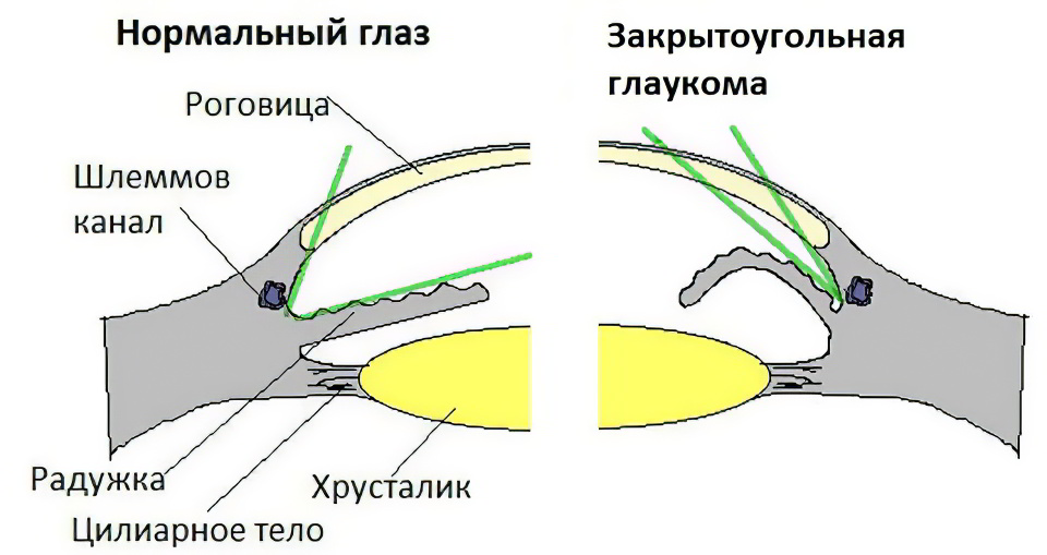 Закрытоугольная глаукома