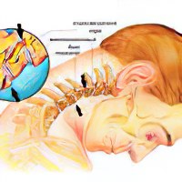 Как вылечить спину если защемило ее