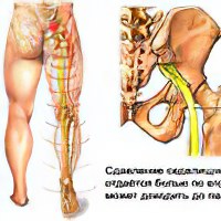 Защемило нерв выше поясницы