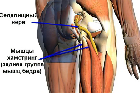 Воспаление седалищного нерва