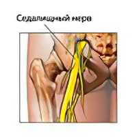 Защемление нерва после операции