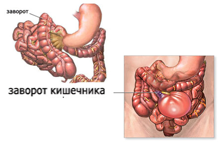 Заворот кишечника