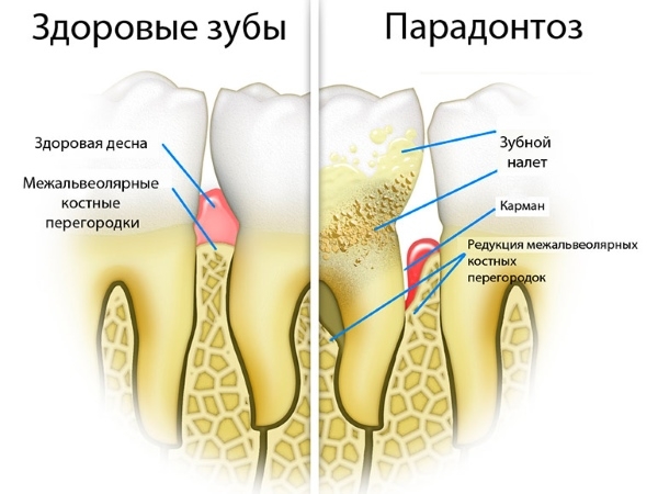 Пародонтоз