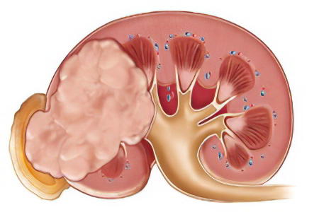Злокачественная опухоль почек