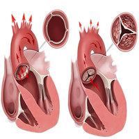 Транскатетерная имплантация аортального клапана