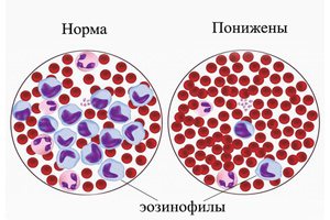 Эозинофилы в крови