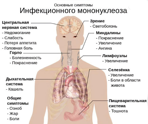 Инфекционный мононуклеоз