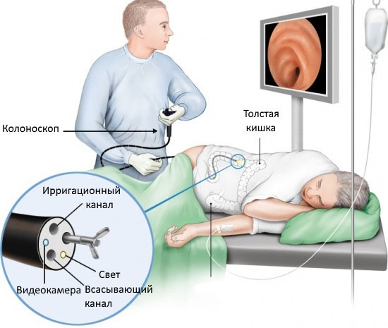 колоноскопия