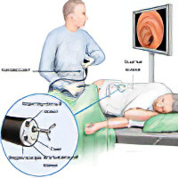 Колоноскопия кишечника