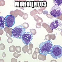 Моноцитоз