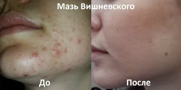 Мазь Вишневского от прыщей