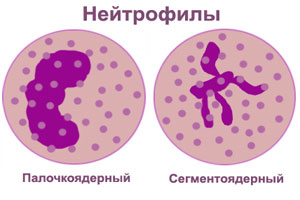 Виды нейтрофилии